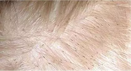 Al menos 12 casos de pediculosis en recién nacidos se han detectado en un año, lo cual es transmitido por parte de la madre a los menores debido a q