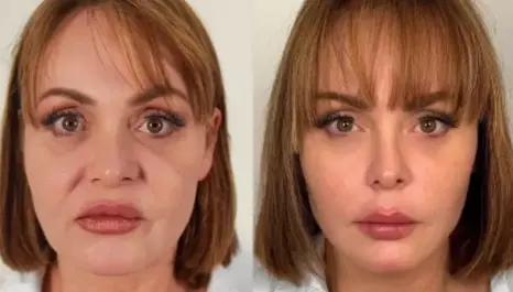 Gabriela Spanic impactó a sus seguidores en redes sociales tras mostrar su antes y después tras realizarse un procedimiento estético en el rostro.