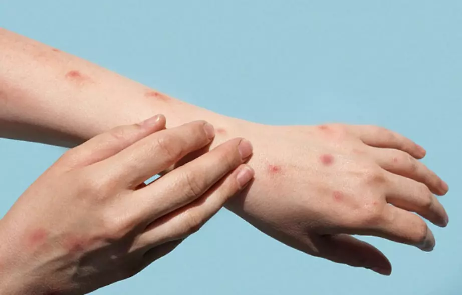 Primer caso de sarampión en Saltillo, es el quinto en Coahuila