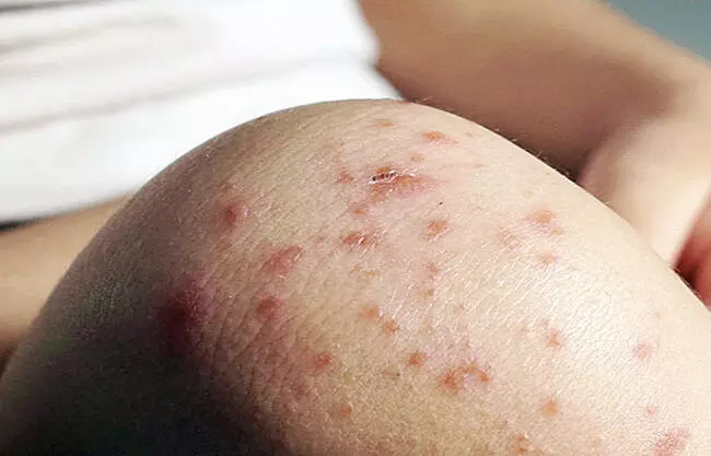 Suman siete contagios de sarampión en Coahuila