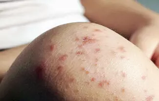 Coahuila llegó a siete casos confirmados de sarampión en lo que va de 2026, luego de que autoridades sanitarias confirmaran dos nuevos contagios en 