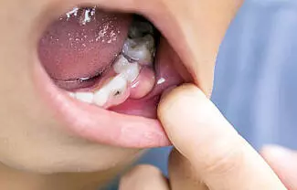 Son más los casos de niños y adolescentes que presentan problemas severos de salud bucal, debido a la mala alimentación